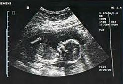 pregnancy_ultrasound.jpg