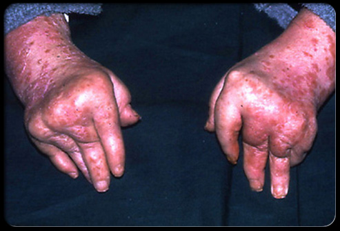 image of psoriatic arthritis hands